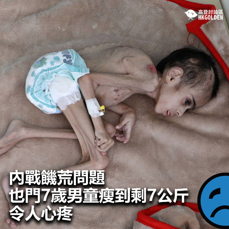 【內戰饑荒問題   也門7歲男童瘦到剩7公斤令人心疼】