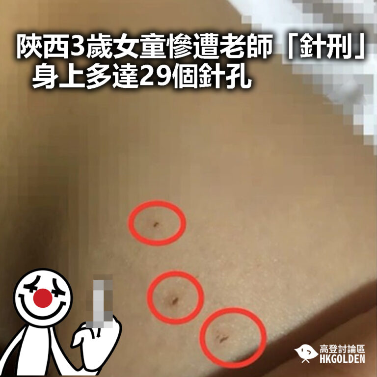 【陝西3歲女童慘遭老師「針刑」  身上多達29個針孔】