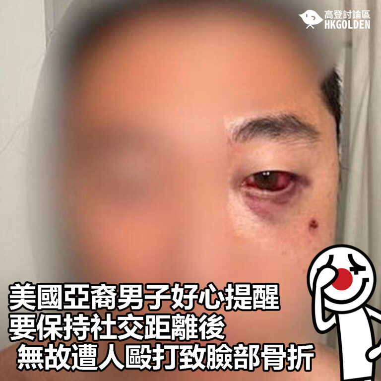 【美國亞裔男子好心提醒要保持社交距離後 無故遭人毆打致臉部骨折】
