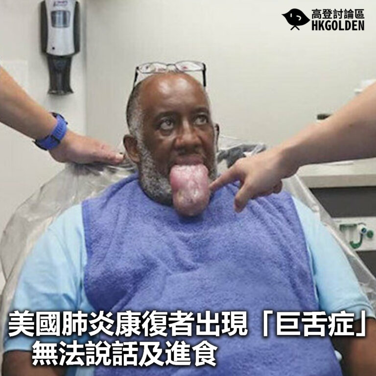 【美國肺炎康復者出現「巨舌症」  無法說話及進食】