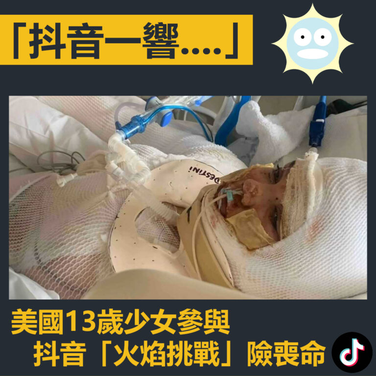 【「抖音一響….」美國13歲少女參與抖音「火焰挑戰」險喪命】