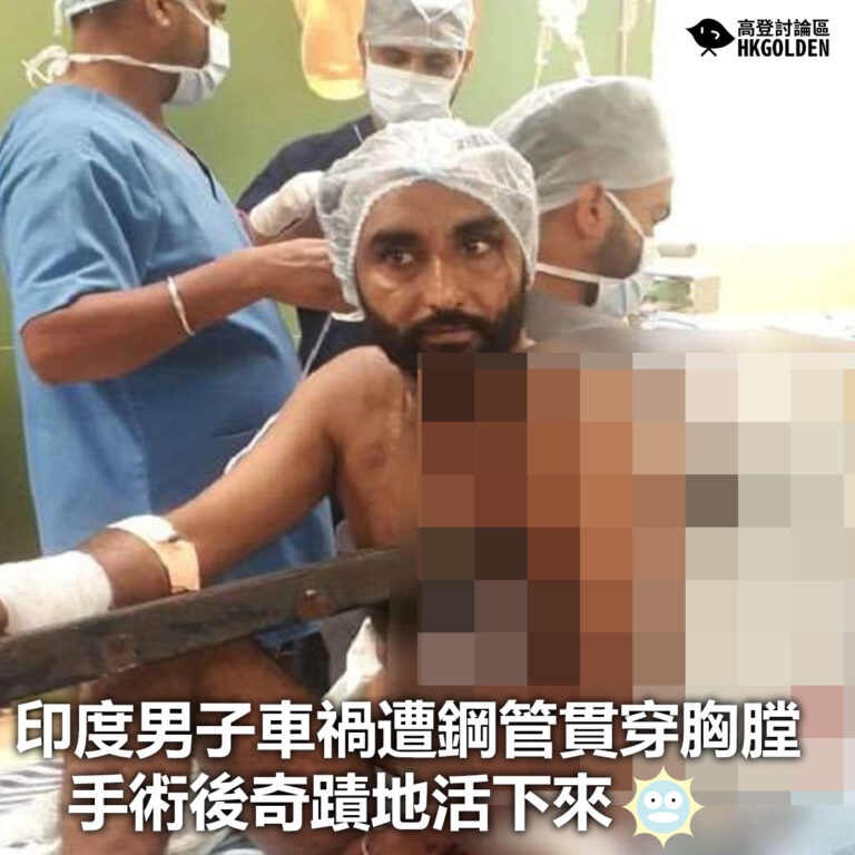 【印度男子車禍遭鋼管貫穿胸膛 手術後奇蹟地活下來】
