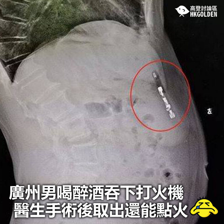 【廣州男喝醉酒吞下打火機 醫生手術後取出還能點火】