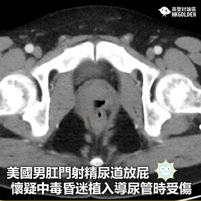【美國男肛門射精尿道放屁 懷疑中毒昏迷植入導尿管時受傷】