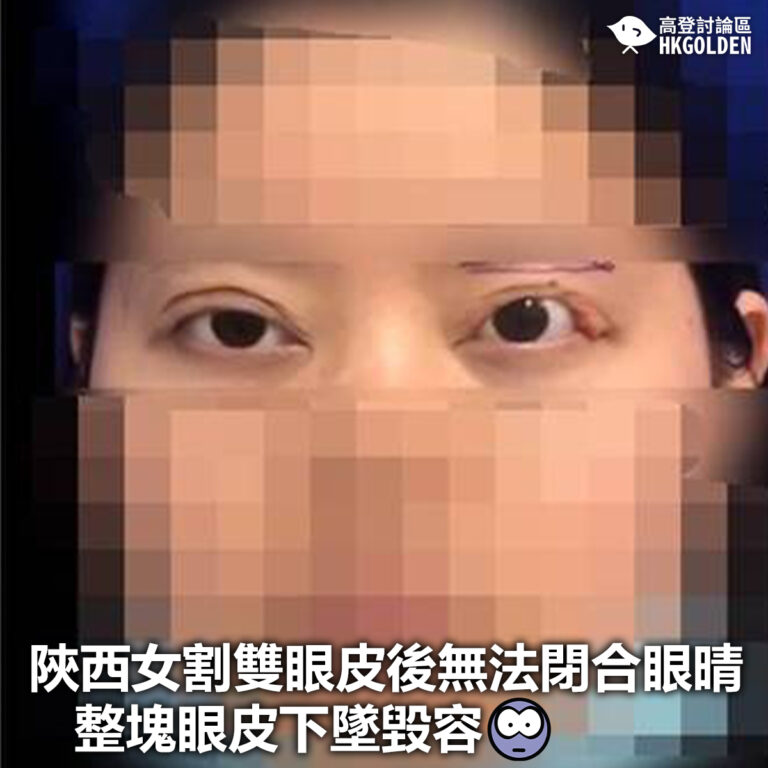【陝西女割雙眼皮後無法閉合眼晴 整塊眼皮下墜毀容】