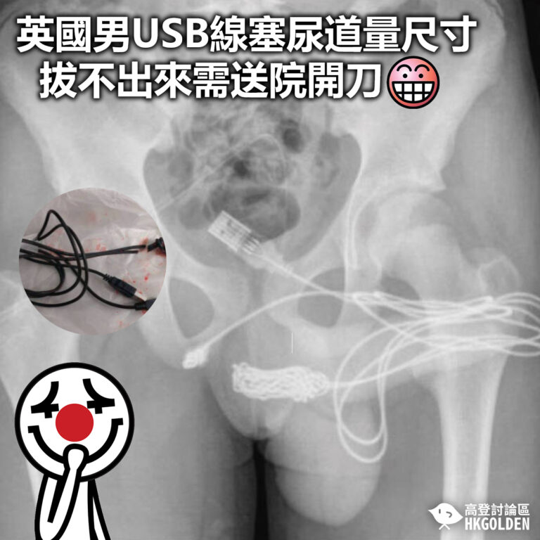 【英國男USB線塞尿道量尺寸 拔不出來需送院開刀】