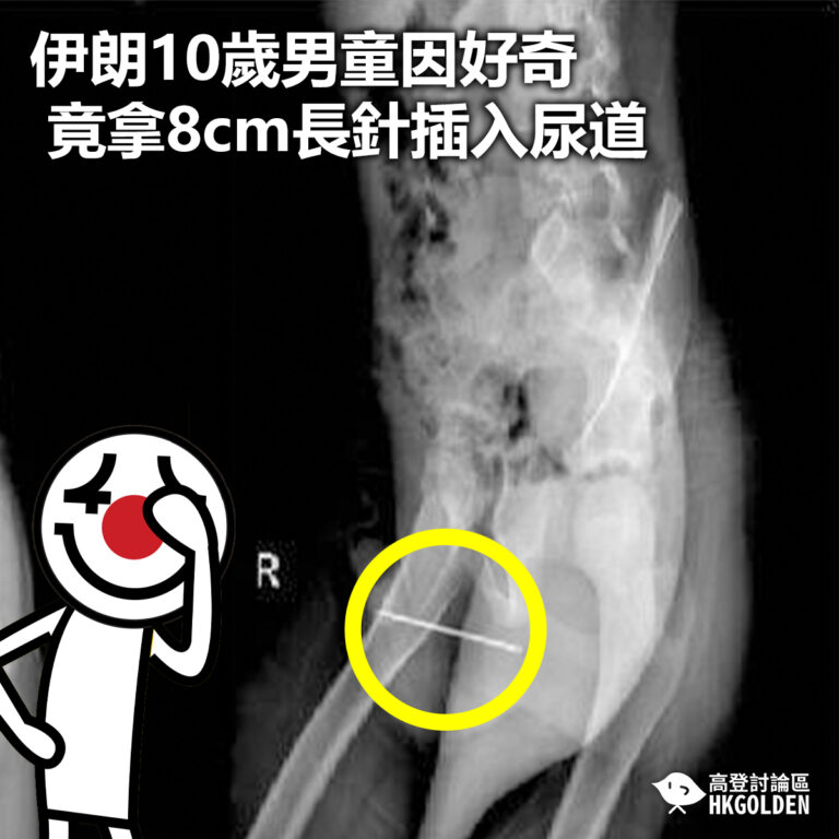 【伊朗10歲男童因好奇 竟拿8cm長針插入尿道】