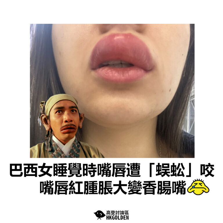 【巴西女睡覺時嘴唇遭「蜈蚣」咬  嘴唇紅腫脹大變香腸嘴】