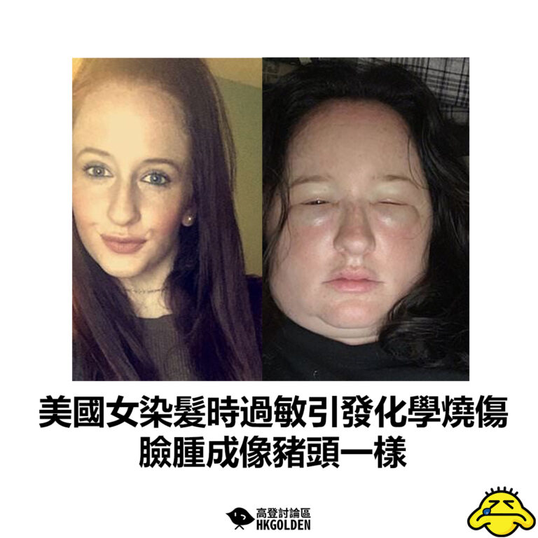 【美國女染髮時過敏引發化學燒傷 臉腫成像豬頭一樣 】