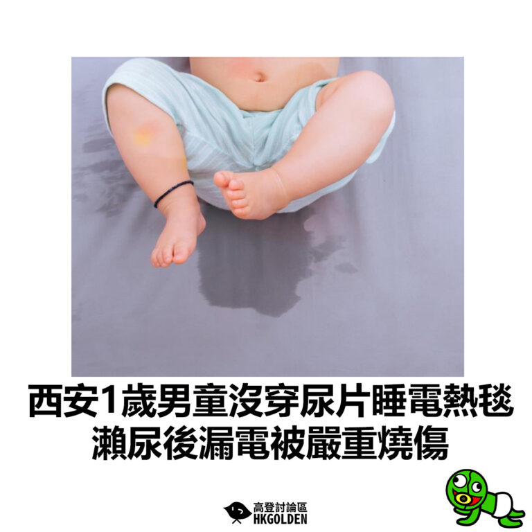 【西安1歲男童沒穿尿片睡電熱毯  瀨尿後漏電被嚴重燒傷 】
