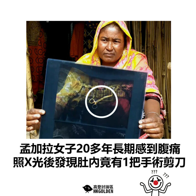 【孟加拉女子20多年長期感到腹痛 照X光後發現肚內竟有1把手術剪刀】