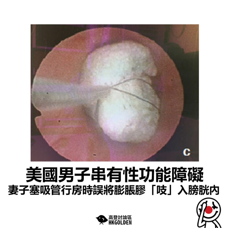 【美國男子性功能障礙 妻子塞吸管行房時誤將膨脹膠「吱」入膀胱內】