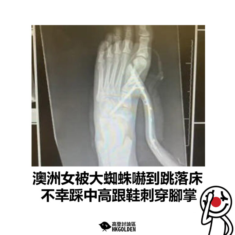 【澳洲女被大蜘蛛嚇到跳落床 不幸踩中高跟鞋刺穿腳掌】