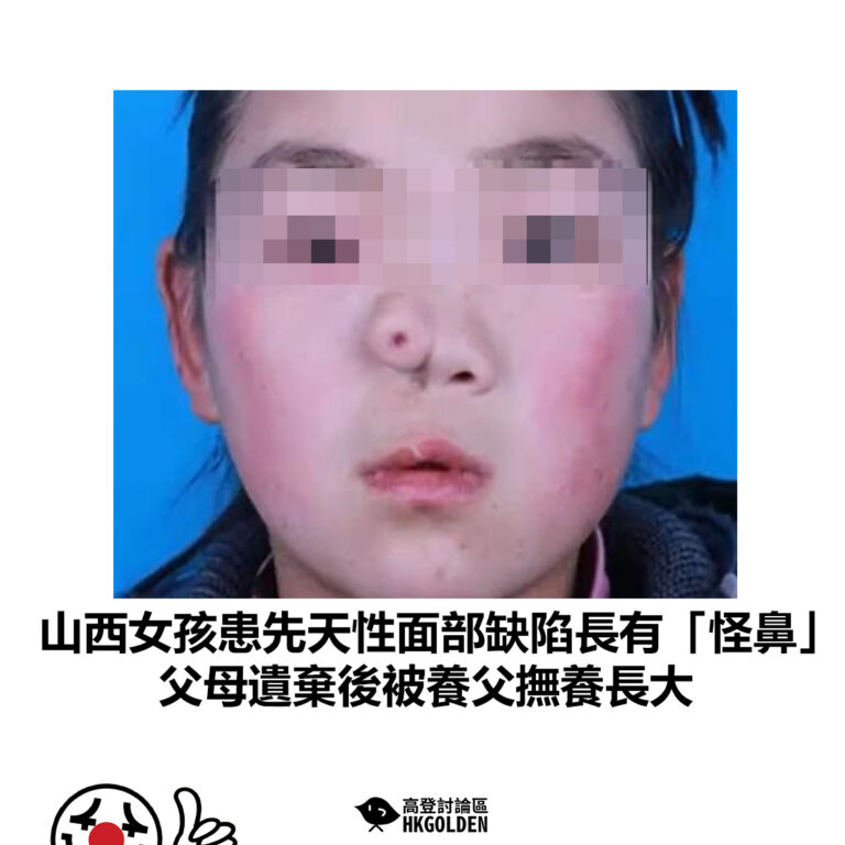 【山西女孩患先天性面部缺陷長有「怪鼻」 父母遺棄後被養父撫養長大】