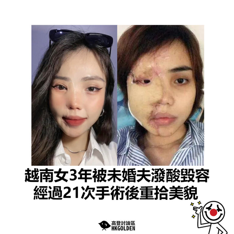 【越南女3年被未婚夫潑酸毀容 經過21次手術後重拾美貌】