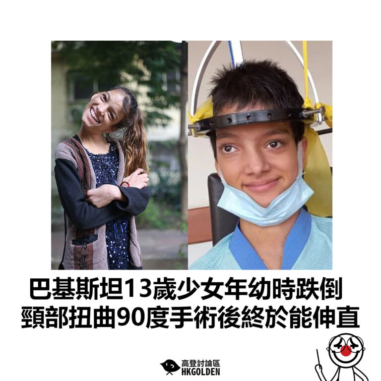 【巴基斯坦13歲少女年幼時跌倒 頸部扭曲90度手術後終於能伸直】