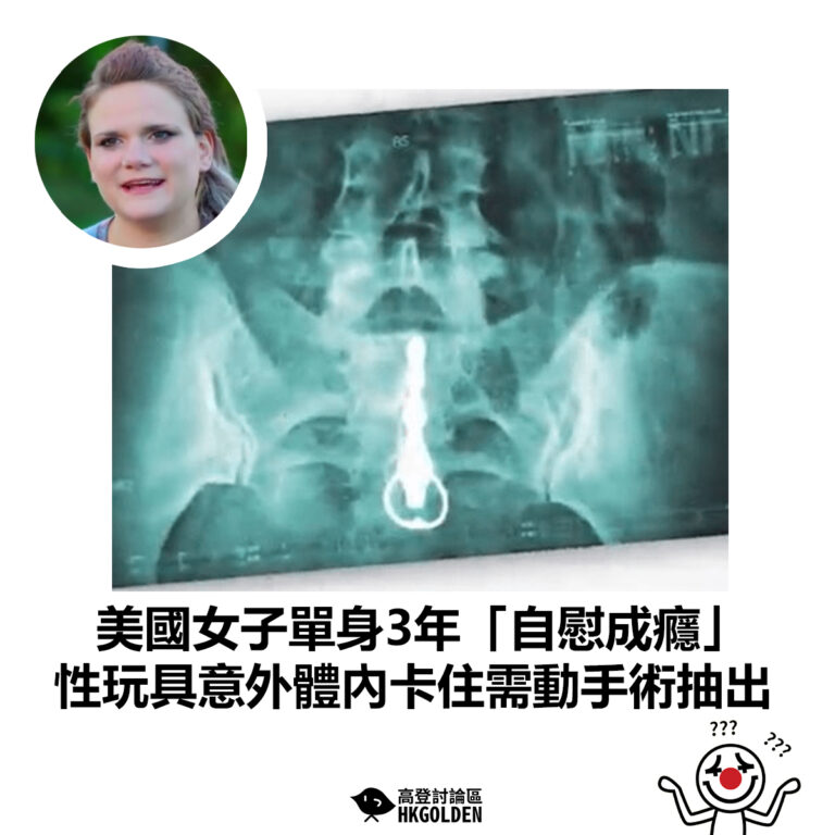 【美國女子單身3年「自慰成癮」 性玩具意外體內卡住需動手術抽出】
