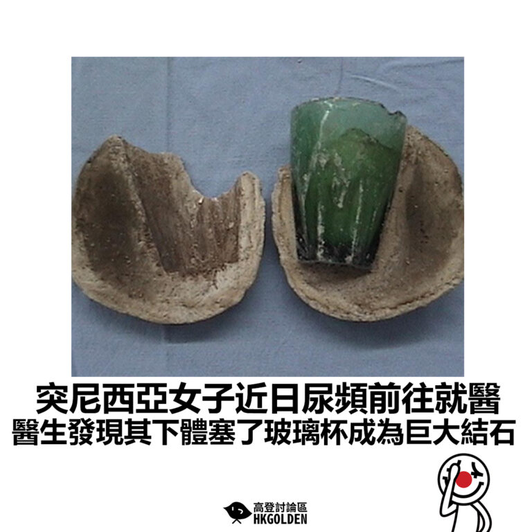 【突尼西亞女子近日尿頻前往就醫 醫生發現其下體塞了玻璃杯成為巨大結石】