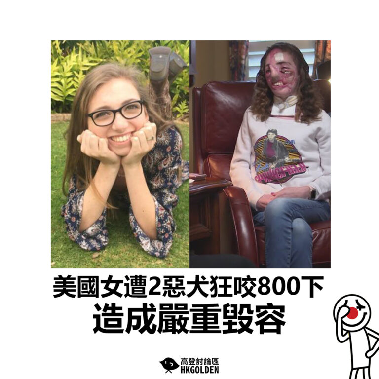 【美國女遭2惡犬狂咬800下 造成嚴重毀容】
