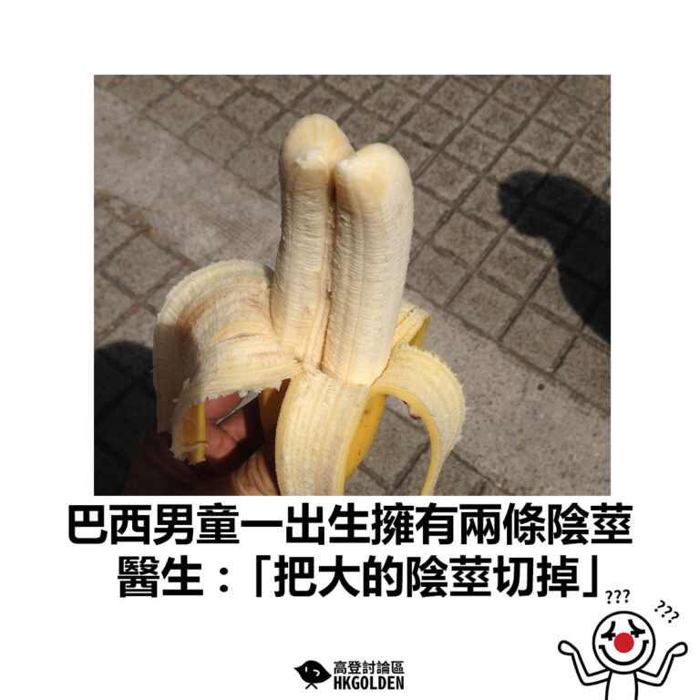 【巴西男童一出生擁有兩條陰莖  醫生: 「把大的陰莖切掉」】