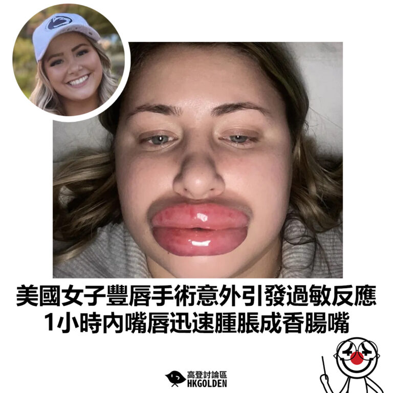 【美國女子豐唇手術意外引發過敏反應 1小時內嘴唇迅速腫脹成香腸嘴】