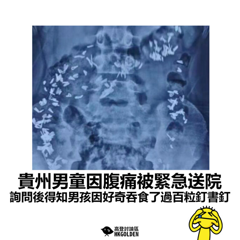 【貴州男童因腹痛被緊急送院  詢問後得知男孩因好奇吞食了過百粒釘書釘】