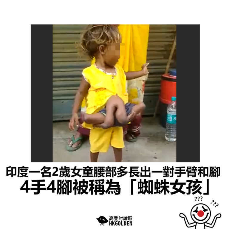 【印度一名2歲女童腰部多長出一對手臂和腳 4手4腳被稱為「蜘蛛女孩」】