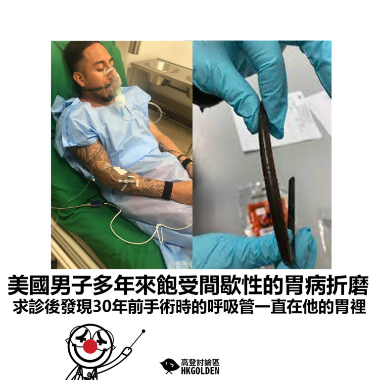 【美國男子多年來飽受間歇性的胃病折磨 求診後發現30年前手術時的呼吸管一直在他的胃裡】
