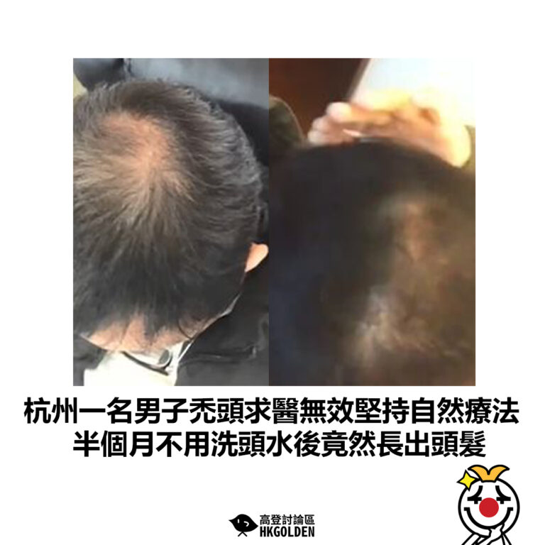 【杭州一名男子禿頭求醫無效堅持自然療法 半個月不用洗頭水後竟然長出頭髮 】
