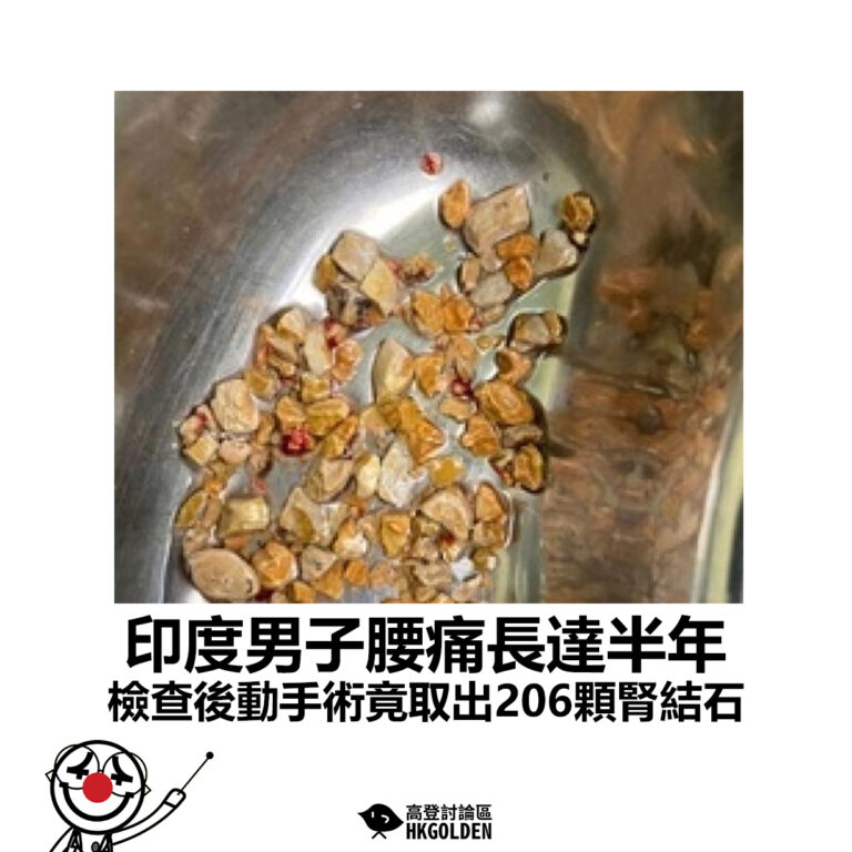 【印度男子腰痛長達半年 檢查後動手術竟取出206顆腎結石】