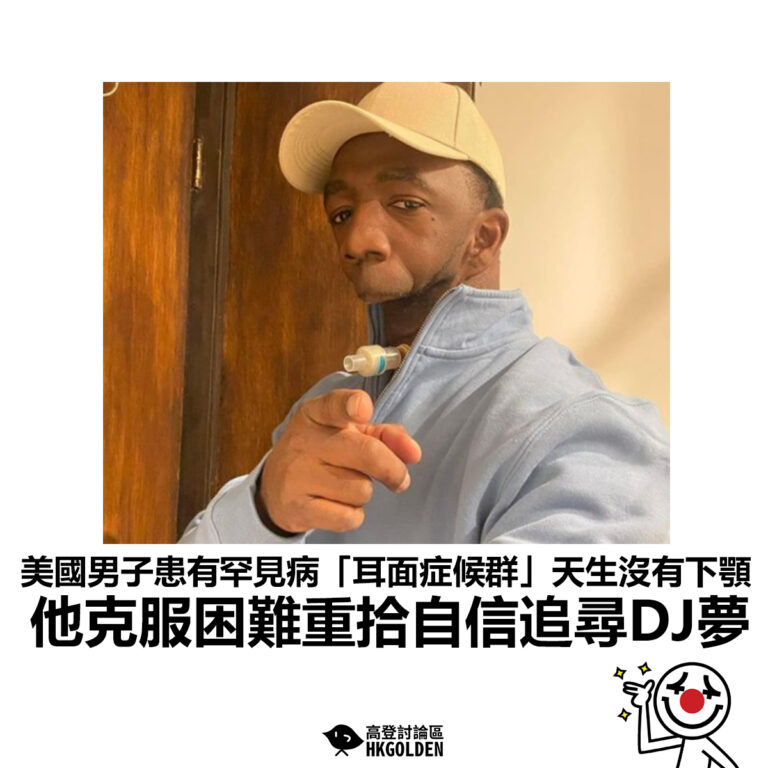 【美國男子患有罕見病「耳面症候群」天生沒有下顎 他克服困難重拾自信追尋DJ夢】