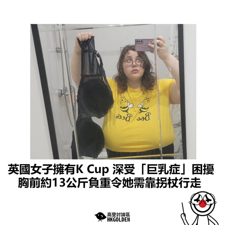 【英國女子擁有K Cup 深受「巨乳症」困擾胸前約13公斤負重令她需靠拐杖行走】
