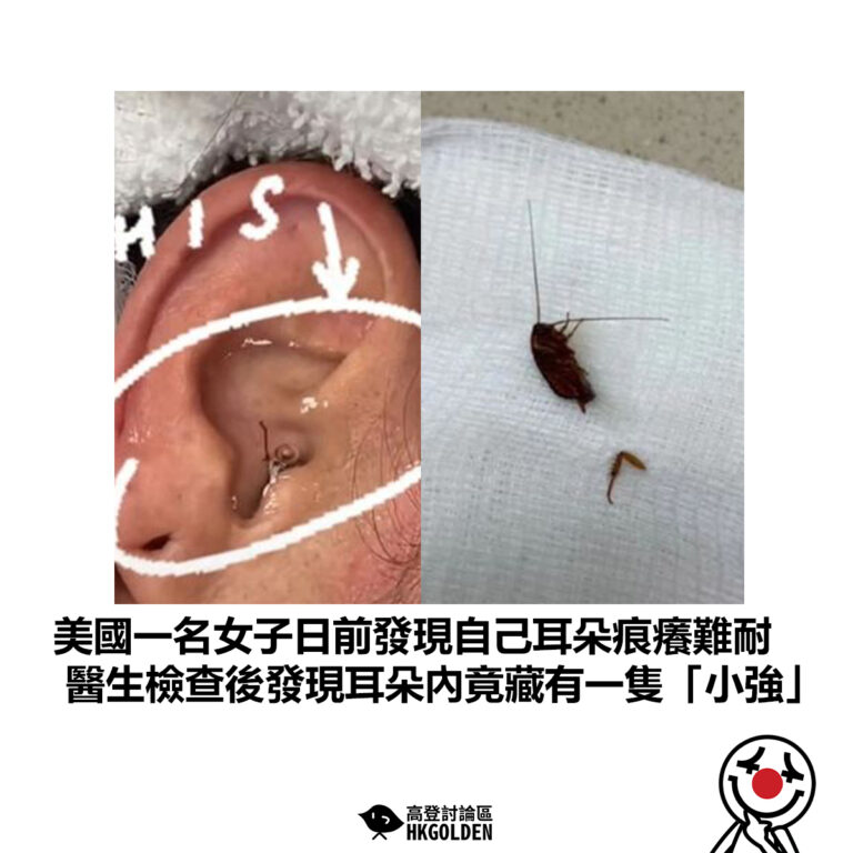 【美國一名女子日前發現自己耳朵痕癢難耐 醫生檢查後發現耳朵內竟藏有一隻「小強」】