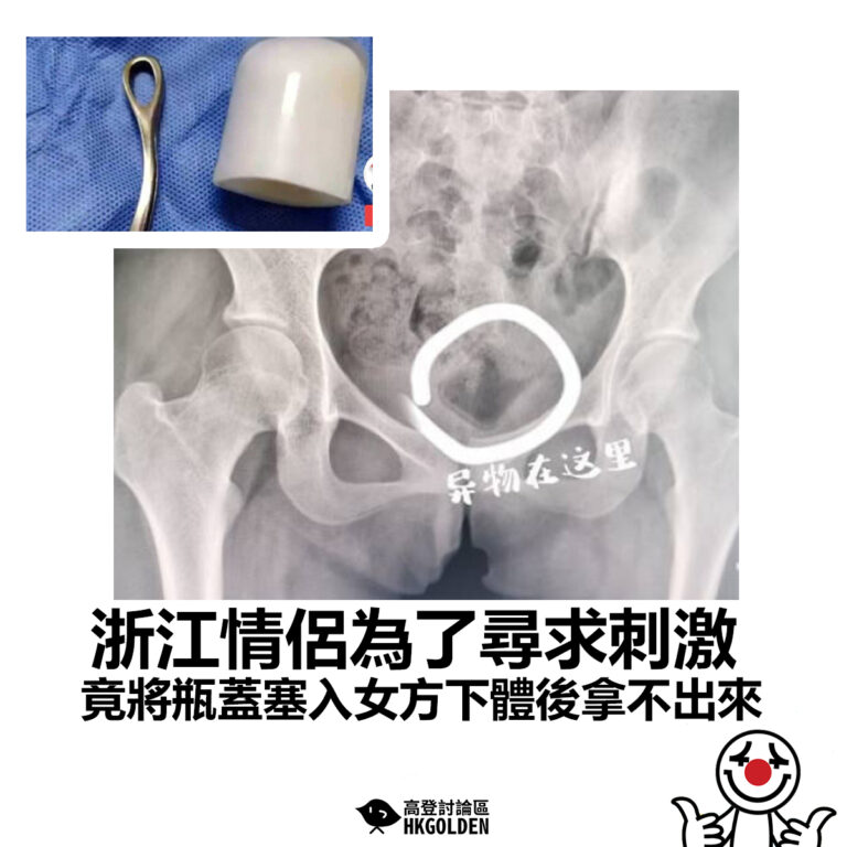 【浙江情侶為了尋求刺激 竟將瓶蓋塞入女方下體後拿不出來】