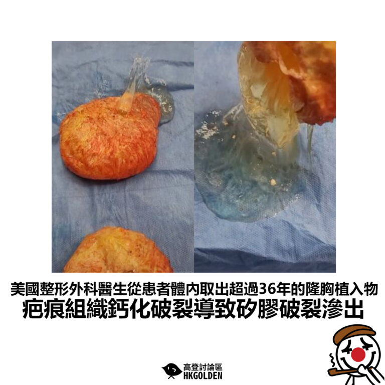 【美國整形外科醫生從患者體內取出超過36年的隆胸植入物 疤痕組織鈣化破裂導致矽膠破裂滲出】