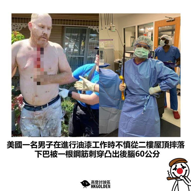 【美國一名男子在進行油漆工作時不慎從二樓屋頂摔落 下巴被一根鋼筋刺穿凸出後腦60公分】