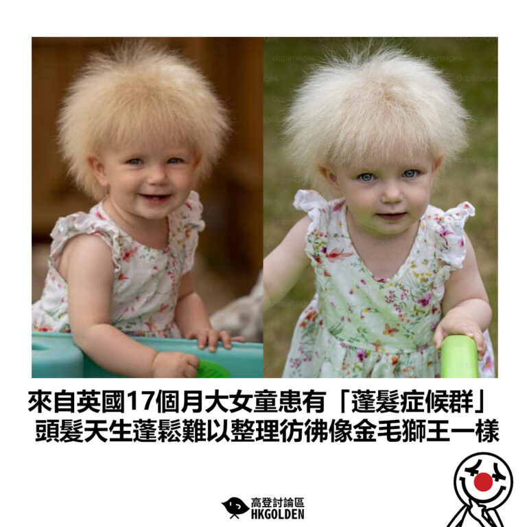 【來自英國17個月大女童患有「蓬髮症候群」 頭髮天生蓬鬆難以整理彷彿像金毛獅王一樣】