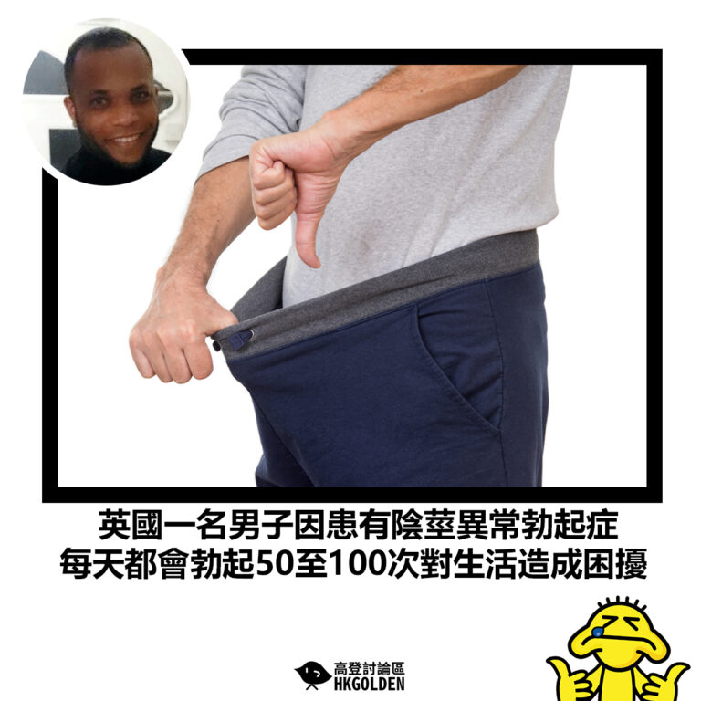 【英國一名男子因患有陰莖異常勃起症 每天都會勃起50至100次對生活造成困擾】