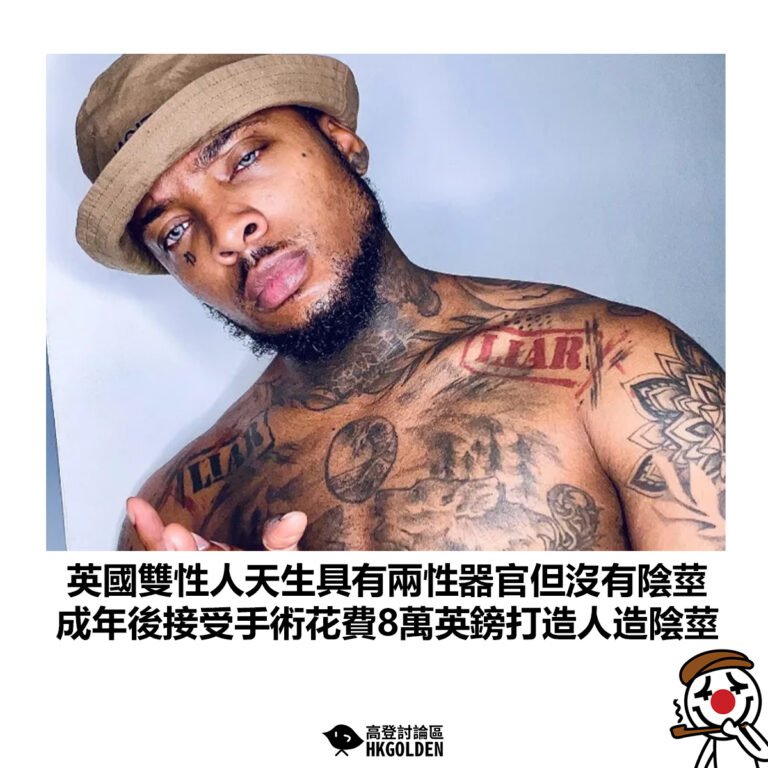 【英國雙性人天生具有兩性器官但沒有陰莖  成年後接受手術花費8萬英鎊打造人造陰莖】