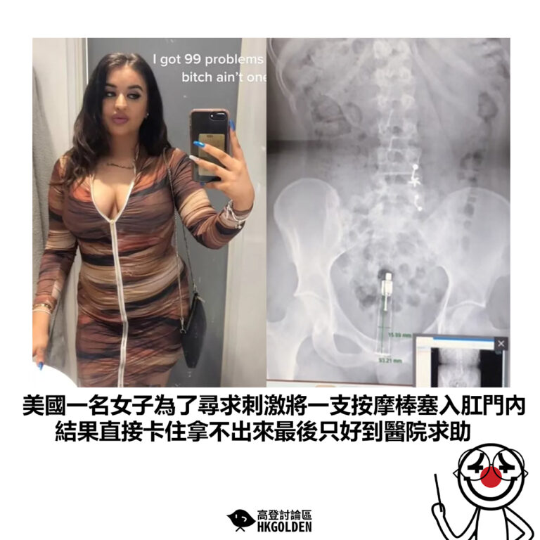 【美國一名女子為了尋求刺激將一支按摩棒塞入肛門內 結果直接卡住拿不出來最後只好到醫院求助】