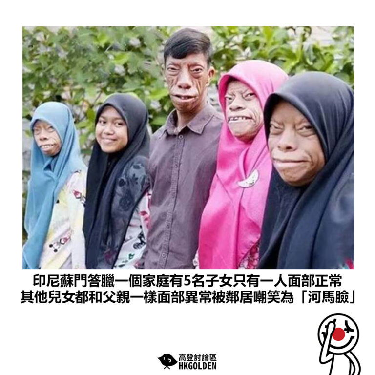 【印尼蘇門答臘一個家庭有5名子女只有一人面部正常 其他兒女都和父親一樣面部異常被鄰居嘲笑為「河馬臉」】