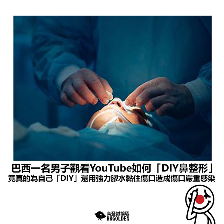 【巴西一名男子觀看YouTube如何「DIY鼻整形」竟真的為自己「DIY」還用強力膠水黏住傷口造成傷口嚴重感染】