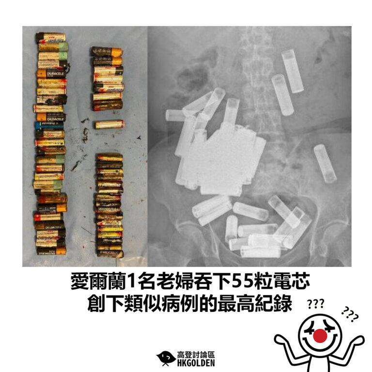 【愛爾蘭1名老婦吞下55粒電芯 創下類似病例的最高紀錄】