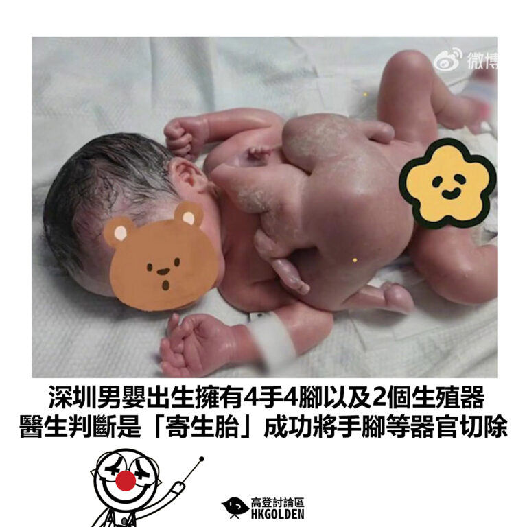 【深圳男嬰出生擁有4手4腳以及2個生殖器 醫生判斷是「寄生胎」成功將手腳等器官切除】