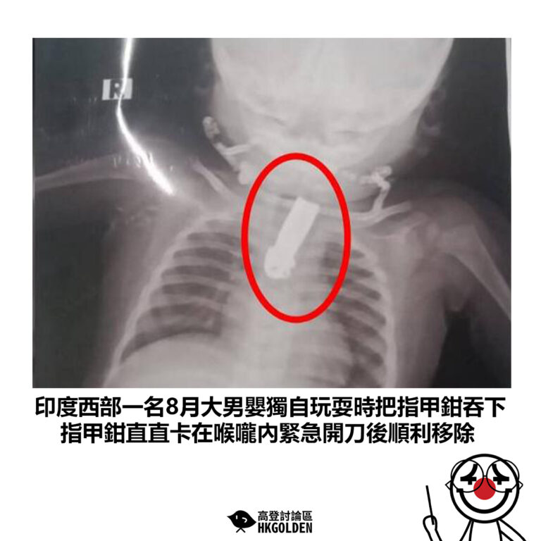 【印度西部一名8月大男嬰獨自玩耍時把指甲鉗吞下 指甲鉗直直卡在喉嚨內緊急開刀後順利移除】