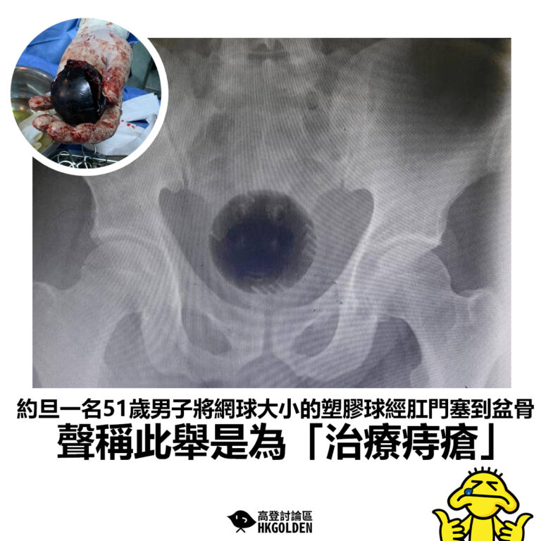 【約旦一名51歲男子將網球大小的塑膠球經肛門塞到盆骨 聲稱此舉是為「治療痔瘡」】