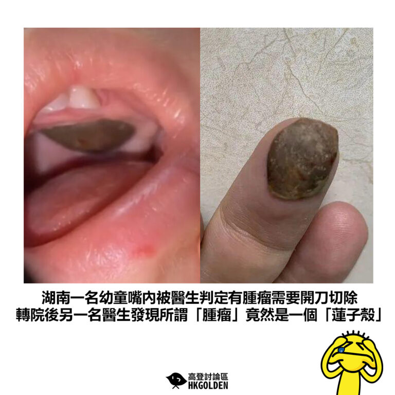 【湖南一名幼童嘴內被醫生判定有腫瘤需要開刀切除 轉院後另一名醫生發現所謂「腫瘤」竟然是一個「蓮子殼」】