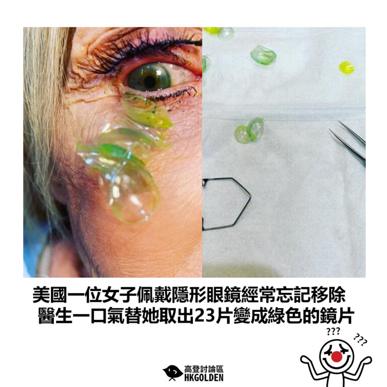 【美國一位女子佩戴隱形眼鏡經常忘記移除 醫生一口氣替她取出23片變成綠色的鏡片】
