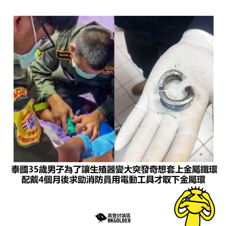 【泰國35歲男子為了讓生殖器變大突發奇想套上金屬鐵環 配戴4個月後求助消防員用電動工具才取下金屬環】