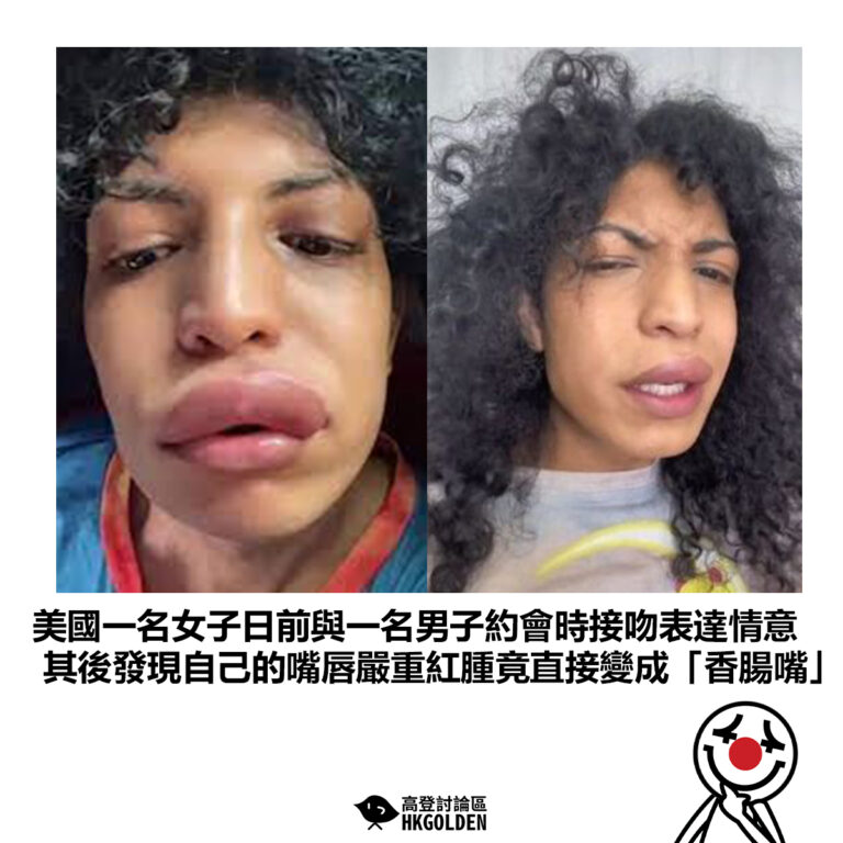 【美國一名女子日前與一名男子約會時接吻表達情意 其後發現自己的嘴唇嚴重紅腫竟直接變成「香腸嘴」】